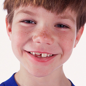 ThreeReasonswhyYourSixYearOldShouldUndergoanOrthodonticCheck