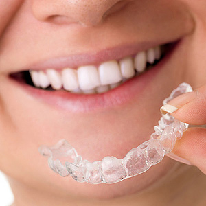 ClearAlignersReduceRiskforDevelopingGumDiseaseBetterthanBraces