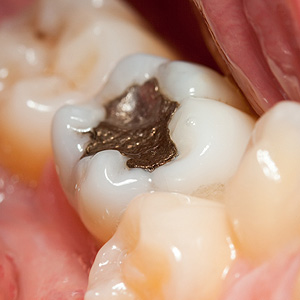 MetalDentalAmalgamStillaSafeandEffectiveToothFilling
