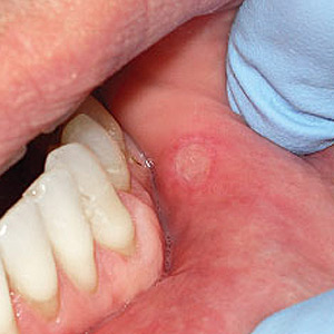 PlaguedbyMysteriousMouthUlcers