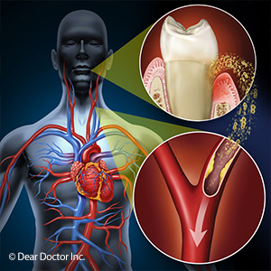 IsThereaLinkBetweenGumDiseaseandCardiovascularHealth