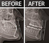 JawSurgerymaybeNecessarytoOvercomeSomeTeethMisalignments