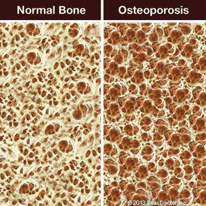 CertainTreatmentsforOsteoporosisCouldComplicateOralSurgery