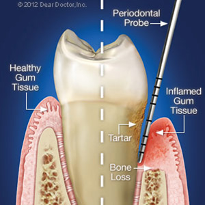 PeriodontalProbingIncreasesAccuracyinDiagnosingGumDisease