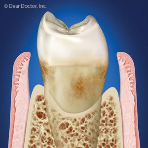 PeriodontalSurgeryAllowsustoAccessDeepSurfacesforPlaqueRemoval