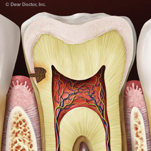 FactorsBesidesOralHygienethatInfluenceYourRiskforToothDecay